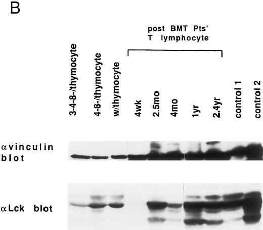 Fig. 4. Endogenous expression of pp125FAK, Cas-L, paxillin, Lck, and vinculin in the whole extracts of thymocytes, post-BMT patients' and healthy volunteers' lymphocytes. (A) Whole thymocytes and peripheral T lymphocytes from post-BMT patients or a normal control (50 μg/lane) were analyzed using anti-FAK MoAb. The same membrane was rehybridized with anti-Cas MoAb followed by anti-paxillin MoAb. (B) Immunodepleted cell population from normal thymocytes using anti-CD3 (OKT3) plus anti-CD4 (19Thy) plus anti-CD8 (21Thy) or anti-CD4 plus anti-CD8 MoAbs, whole thymocytes, and peripheral T lymphocytes from post-BMT patients or normal controls were lysed. Each cell lysate (50 μg/lane) was subjected to Western blotting with anti-Lck MoAb followed by anti-vinculin MoAb.