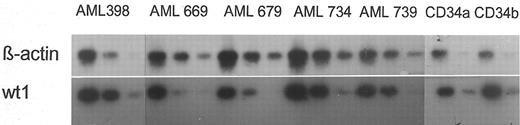 Fig. 1. Expression of β-actin and wt1 genes in 5 representative AML blast samples and 2 CD34+ normal progenitor populations. Amplification of the cDNA derived from AML blasts was performed with 100 (left), 10−1 (medium), and 10−2 (right) dilutions. cDNA derived from normal cells was diluted 100 (left) and 10−1 (right) due to the lower cell number obtaind for RNA extraction. Dilutions were performed to avoid PCR saturation due to initial excess of template.