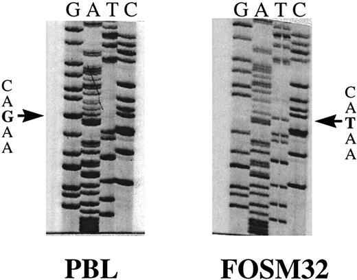 Fig. 3. Sequence analysis of FasIII RT-PCR products extracted from SSCP gels. Sequence shown is bp 966 to 1011, including the point mutation G to T at bp 999 in patient FOSM32. The normal PB sequence is shown on the left (PBL).