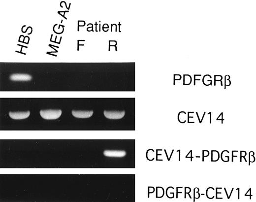 Fig. 7. RT-PCR analysis of wild-type and chimeric transcripts. RNA samples were reverse transcribed and then amplified with 5′ and 3′ PDGFRβ primers (PDGFRβ), 5′ and 3′ CEV14 primers (CEV14), 5′ CEV14 and 3′ PDGFRβ primers (CEV14-PDGFRβ), or 5′ PDGFRβ and 3′ CEV14 primers (PDGFRβ-CEV14). PCR products were electrophoresed on 2% agarose gels and stained with ethidium bromide.