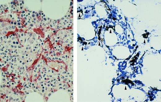 Fig. 1. BM biopsy sample from patient with myeloma with in situ hybridization for KSHV ORF 72. Biotin-labeled probe is localized to BM stromal cells (arrowheads, brown) (left). Immunohistochemical stain for fascin (red) shows a similar distribution of BM dendritic cells within the stroma (right). Hematoxylin counterstain; original magnification × 400.