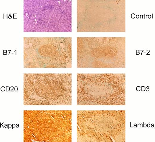 Fig. 1. Follicular lymphomas express B7-1 and B7-2 on the cell surface in situ. Immunoperoxidase staining of a representative small cleaved follicular center cell lymphoma using the Vectastain ABC Elite reagents. For B7-1, MoAb clone EW3.4B2.C4 was used and for B7-2 detection clone HA5.2B7. Similar staining for B7-1 and B7-2 were seen using other B7-1 or B7-2 MoAbs or CTLA4-Ig, respectively.