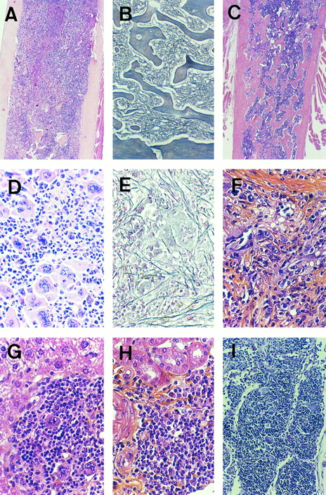 Fig. 11. Histologic sections of tissues from MPZenTPO reconstituted mice studied 2 or 7 months posttransplant. (A) Myeloid hyperplasia in the femur from a mouse 2 months after transplantation. Note the elevated cell concentration in the center of the bone cavity (hematoxylin-eosin staining; original magnification × 40). (B and C) Myelofibrosis demonstrated by deposition of reticulin fibers and osteosclerosis in the femur 7 months posttransplant (Gordon-Sweet and hematoxylin-eosin stainings, respectively; original magnification × 100 and × 40, respectively). (D) Megakaryocytic hyperplasia in the spleen 2 months posttransplant (hematoxylin-eosin staining, original magnification × 400). (E) Fibrosis (Gordon-Sweet staining, original magnification × 400) and (F) accumulation of collagen fibers (hematoxylin-eosin staining, original magnification × 400) in spleen 7 months posttransplant. Extramedullary hematopoiesis seen in liver (G), kidney (H), and lymph node (I) 7 months posttransplant (hematoxylin-eosin, hematoxylin-eosin and Periodic Acid Schiff stainings, respectively; original magnification × 400, × 400, and × 250, respectively).