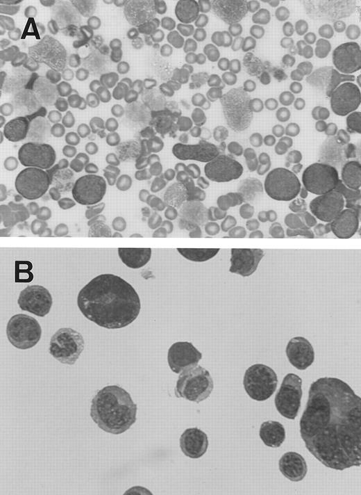 Fig. 7. Blast cells from two MPZenTPO recipient mice that died prematurely after transplantation with elevated nucleated blood cell counts (May-Grünwald-Giemsa staining; original magnification × 100). (A) Blood smear from the first mouse, (B) cytospin smear from peritoneal cells of the second mouse (note the presence of two megakaryocytes).