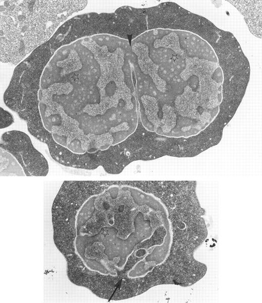 Bone marrow erythroblasts from a patient with congenital dyserythropoietic anemia type I: chromatin bridges between two adjacent nuclear lobes (arrow-head), spongy appearance of the chromatin (stars), and widening of nuclear pores with nucleus invasion by the cytoplasm (arrow) are characteristic ultrastructural features of the disease. Original magnification × 10,400. (Courtesy of Elisabeth M. Cramer and Josette Guichard, INSERM U.91, Hopital Henri Mondor, 94010 Creteil, France.)