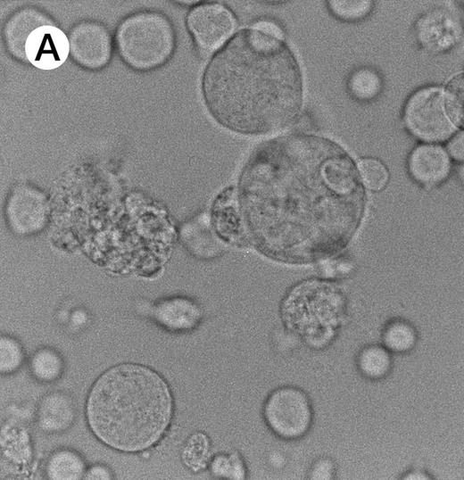 Fig. 2. Morphologic examination of syncytia in HHV-7–infected SupT1 cultures (8 day pi) by light (A) and electron (B through E) microscopy. (A) Field with three syncytia and various single cells. (B) Multinucleated syncytium with an intact morphology. (C) Particular of a necrotic syncytium with vacuolized cytoplasm and initial discontinuation of the plasma membrane. Also note the lack of nuclear chromatin condensation. In (B) and (C), virions appear as dark points (asterisks). (D) Ringed nucleocapsids with an electron-dense core in the cytoplasm of a necrotic syncytium. (E) Particular of a syncytium in advanced stage of necrosis (bottom left), releasing mature virions (asterisks) in proximity of an intact cell (top right). N, nucleus; cy, cytoplasm; v, vacuole; pm, plasma membrane. Original magnifications: (A) ×400; (B and C) ×6,000; (D) ×36,000; and (E) ×7,000.