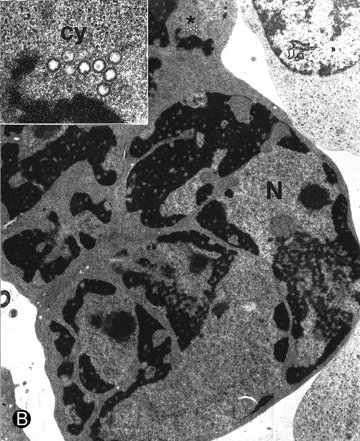 Fig. 6. Ultrastructural examination of apoptotic SupT1 cells by transmission electron microscopy (8 day pi). In (A), two apoptotic nuclei in cells that do not show viral particles. / In (B), note the presence of empty capsids (asterisk) in the cytoplasm of an apoptotic cell (see also the insert at the top left). All cells show chromatin condensation, a characteristic feature of apoptosis. N, nucleus; cy, cytoplasm. Original magnifications: (A) ×4,400 and (B) ×8,800; insert in (B) ×40,000.
