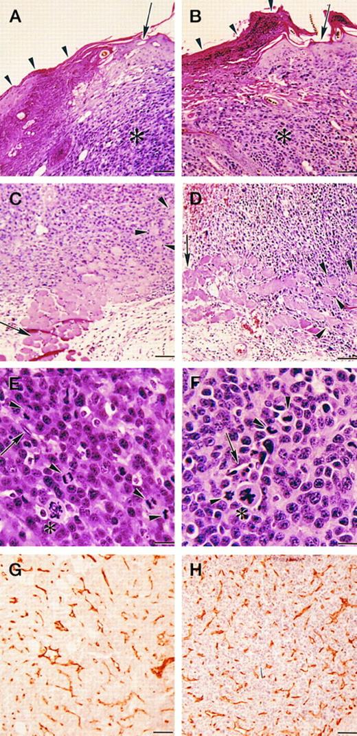 Fig. 3. Histologic appearance of primary tumors in Plg−/− and control mice. Hematoxylin/eosin stain (A through F ) and PECAM immunostain (G and H) of primary tumors 11 days after tumor inoculation. (A and B) Typical appearance of skin overlying the primary tumor in a Plg−/− mouse (A) and a control mouse (B). Both tumors exhibit skin breakdown with surface accumulation of serum proteins, exudate, and dead cell debris (escar). The arrow indicates intact skin. Arrowheads indicate escar. The asterisk indicates tumor. Bar = 100 μm. (C and D) Tumor invasion of dermal muscle in a Plg−/− mouse (C) and a control mouse (D). Both tumors display diffuse invasion with separation and destruction of myocytes. The arrow indicates intact muscle. Arrowheads indicate muscle invaded by tumor. Bar = 100 μm. (E and F ) High magnification micrographs of the tumor in a Plg−/− mouse (E) and a control mouse (F ). The micrographs show similar cytologic features with dense cellularity and severe anaplasia characterized by variation in cell size and shape and numerous mitoses (arrowheads), with some being bizarre (asterisk). Capillaries and endothelial cells are frequent in each tumor (arrows). Bar = 22 μm. (G and H) Immunostain for endothelial cells (PECAM) confirms the presence of numerous vessels in both Plg−/− mice (G) and control mice (H). Bar = 100 μm.
