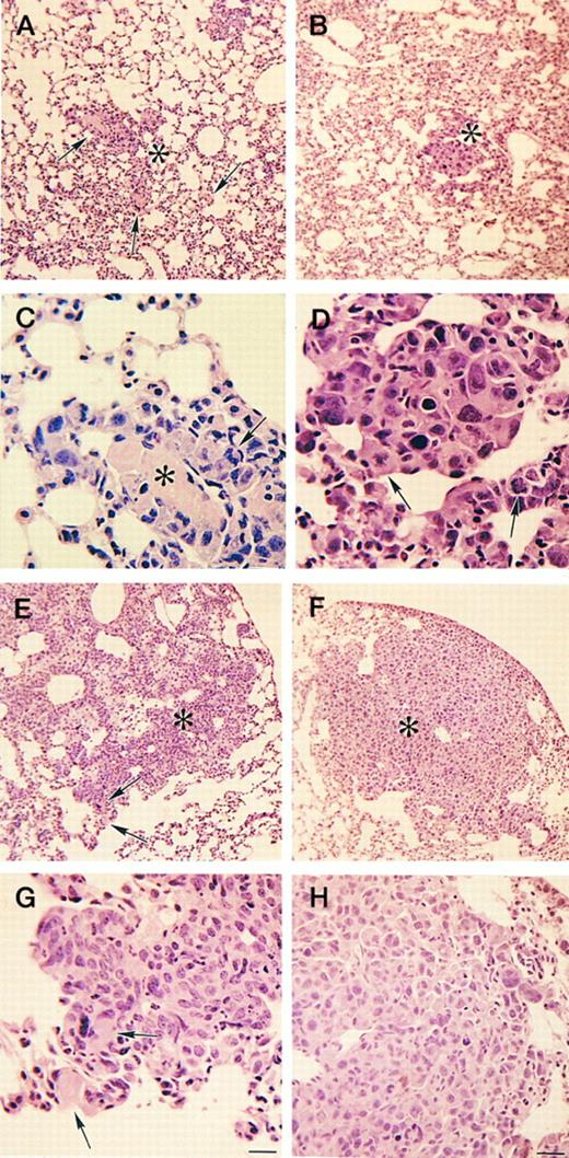 Fig. 4. Histologic appearance of lung metastases in Plg−/− and control mice. Representative examples of lung sections of Plg−/− mice (A, C, E, and G) and control mice (B, D, F, and H) 15 days after tumor cell inoculation stained with hematoxylin/eosin. (A and B) Clusters of small metastatic foci (asterisk) are numerous in the lungs of both Plg−/− mice (A) and control mice (B). Small fibrin thrombi are numerous in Plg−/− mice (arrows). Bar = 100 μm. (C and D) Higher magnification of these metastatic foci show cytologic features similar to the primary tumor in both Plg−/− mice (C) and control mice (D). Metastatic foci are often associated with fibrin thrombi in Plg−/− mice (asterisk) but rarely in control mice. Abnormal mitoses are indicated with arrows. Bar = 22 μm. (E and F ) Examples of large metastatic foci (asterisk) of Plg−/− mice (E) and control mice (F ). Large metastatic foci in Plg−/− mice tend to incorporate thrombi (arrows), whereas this is rare in control mice. (G and H) Higher magnification of large metastatic foci shows similar cytologic features in Plg−/− mice (G) and control mice (H). Fibrin deposits are indicated with arrows. Bar = 22 μm.