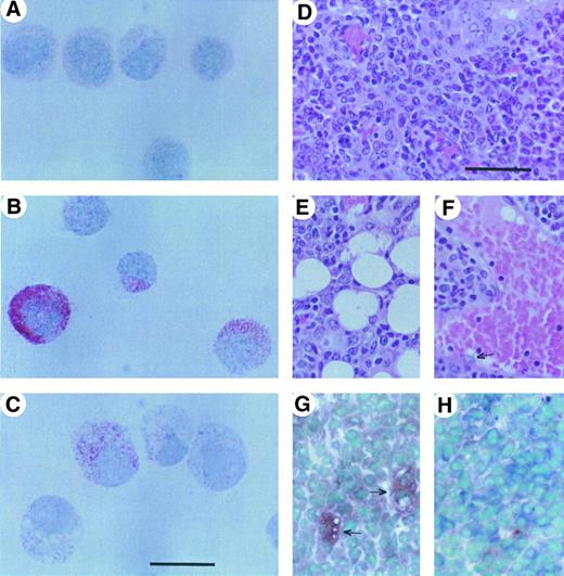 Fig. 9. Expression of human Kit as detected by APAAP (A through C) and tumor histopathology (D through H). The red color shown in the photographs in (A through C) indicates the presence of human Kit protein detected with IDC3 antibody on parental MTHC (A), WTKit-expressing MTHC (B), and V816Kit-expressing MTHC (C). The parental cells do not express human c-Kit and, therefore, (A) represents a negative control. The bar in (C) represents 15 μm and provides the scale for (A, B, and C). The right panel shows photographs of tumor sections. Photographs (D, E, and F ) show hematoxylin and eosin staining of a paraffin-embedded tumor section and (G and H) show esterase expression in frozen sections. (D) Shows a region through the center of the vascularized tumor, (E and F ) show invasion of the tumor cells into surrounding fat tissue and a blood vessel, respectively. (G and H) Show regions of staining for predominantly macrophage or neutrophil esterase, respectively. The arrows in photograph (G) indicate the larger cells showing phagocytosis of other cells. The bar in (D) represents 38 μm and provides the scale for (D) through (H).