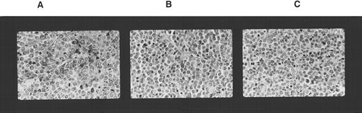 Fig. 4. Lymphocyte subsets infiltrating tumor tissue. Immunological staining of tumor sections excised 2 weeks after adoptive transfer of PBMC. The sections were fixed in paraffin and stained with anti-NK1 MoAb. (A) K562 cell tumor; (B) K562DR1 cell tumor; (C) K562 cell tumor in the absence of adoptively transferred PBMC.