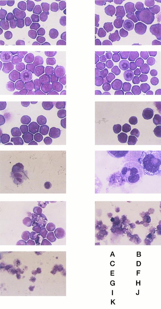 Fig. 4. The morphologic changes of the wild-type and transformant HL-60 cells on IPTG stimulation. (A) and (B) Wild-type HL-60 cells. (C) and (D) Mock-transfected HL-60 cells. (E), (F), (G), (H), (I), (J), and (K) NF-1 cells. (A), (C), and (E) Without IPTG. (F) With IPTG for 24 hours. (G) and (H) With IPTG for 48 hours. (I) With IPTG for 60 hours. (J) With IPTG for 84 hours. (B), (D), and (K) With IPTG for 96 hours. Original magnification: (H) × 1000, and others × 400.