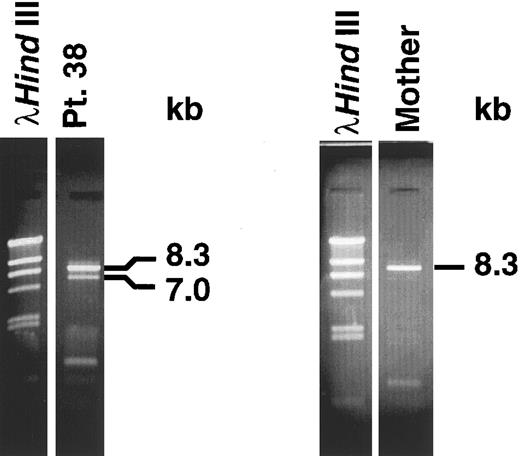 Fig. 2. Panhandle PCR products. A 7.0-kb product from der(11) chromosome and 8.3-kb product from the normal MLL allele were obtained from leukemic marrow DNA of patient 38 (left). An 8.3-kb product from normal MLL alleles was obtained from maternal peripheral blood lymphocyte DNA (right).