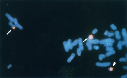 Fig. 1. FISH analysis of the leukemic metaphase chromosomes. Chromosome 22 and a phage clone λhp300-2 were detected with TRITC and FITC, respectively. Split signals of λhp300-2 are observed on the boundary between WCP22-painted and unpainted regions of der(11)t(11; 22) and der(22)t(11; 22) (arrows). The intact signal of λhp300-2 was observed on the normal chromosome 22 (arrowhead).