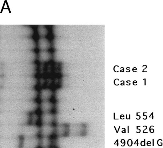 Fig. 3. Genomic analysis of mutant fibrinogen Aα-chain gene. (A) Autoradiography of SSCP gel for exon 5 of fibrinogen Aα-chain gene. Cases no. 1 (affected father) and 2 (affected son) presented abnormal migrating bands in addition to the normal ones. DNAs with the known amyloidogenic fibrinogen Aα gene mutations Leu554, Val526 and 4904delG, were analyzed on the same gel for comparison. Unlabeled lanes are normal controls. (B) Autoradiography of DNA sequencing gel of exon 5 of the propositus. The propositus is heterozygous with the normal fibrinogen Aα-chain gene and the mutant gene that is missing T at the second base of codon 522. (C) Ethidium bromide-stained agarose gel of PCR-induced mutation restriction analysis for the detection of the 4897delT mutant gene. Case no. 1, affected father; case no. 2, affected son; controls no. 1 and 2, normal subjects; marker, DNA size marker (ΦX 174 DNA-HaeIII digest). The numbers on the left denote the sizes of the bands in basepairs.