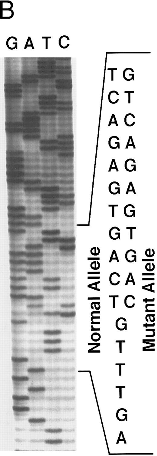 Fig. 3. Genomic analysis of mutant fibrinogen Aα-chain gene. (A) Autoradiography of SSCP gel for exon 5 of fibrinogen Aα-chain gene. Cases no. 1 (affected father) and 2 (affected son) presented abnormal migrating bands in addition to the normal ones. DNAs with the known amyloidogenic fibrinogen Aα gene mutations Leu554, Val526 and 4904delG, were analyzed on the same gel for comparison. Unlabeled lanes are normal controls. (B) Autoradiography of DNA sequencing gel of exon 5 of the propositus. The propositus is heterozygous with the normal fibrinogen Aα-chain gene and the mutant gene that is missing T at the second base of codon 522. (C) Ethidium bromide-stained agarose gel of PCR-induced mutation restriction analysis for the detection of the 4897delT mutant gene. Case no. 1, affected father; case no. 2, affected son; controls no. 1 and 2, normal subjects; marker, DNA size marker (ΦX 174 DNA-HaeIII digest). The numbers on the left denote the sizes of the bands in basepairs.