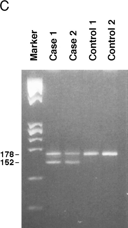 Fig. 3. Genomic analysis of mutant fibrinogen Aα-chain gene. (A) Autoradiography of SSCP gel for exon 5 of fibrinogen Aα-chain gene. Cases no. 1 (affected father) and 2 (affected son) presented abnormal migrating bands in addition to the normal ones. DNAs with the known amyloidogenic fibrinogen Aα gene mutations Leu554, Val526 and 4904delG, were analyzed on the same gel for comparison. Unlabeled lanes are normal controls. (B) Autoradiography of DNA sequencing gel of exon 5 of the propositus. The propositus is heterozygous with the normal fibrinogen Aα-chain gene and the mutant gene that is missing T at the second base of codon 522. (C) Ethidium bromide-stained agarose gel of PCR-induced mutation restriction analysis for the detection of the 4897delT mutant gene. Case no. 1, affected father; case no. 2, affected son; controls no. 1 and 2, normal subjects; marker, DNA size marker (ΦX 174 DNA-HaeIII digest). The numbers on the left denote the sizes of the bands in basepairs.