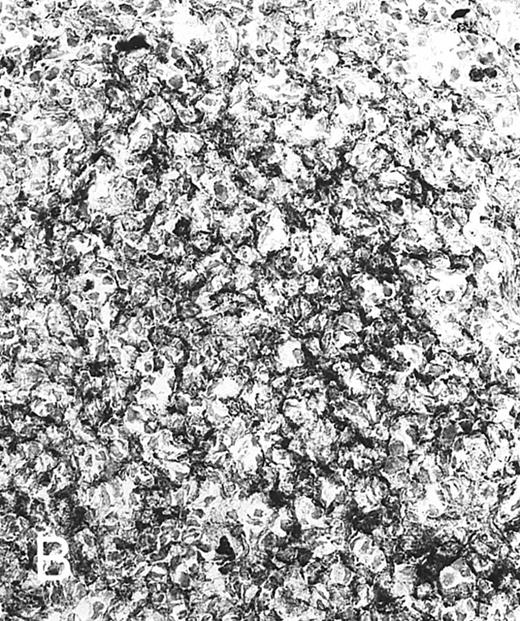 Fig. 4. Expression of TNFR I in tonsillar lymphoid follicle. (A and B) Immunostains of TNFR I. A lacy positive pattern (A) is evident in the apical and basal light zones. High-power view of the basal light zone, showing a heavily labeled lacy pattern (B). MZ, mantle zone; LZ, light zone; DZ, dark zone. (A) Original magnification × 98, (B) Original magnification × 300. (C and D) Immunoelectron micrographs of TNFR I in the tonsillar light zone. The cell surface of a binucleated FDC and the surface of the labyrinth-like structure of FDC embracing lymphocyte (L) are positively stained. Bar = 1 nm. (C) Original magnification × 5,700, (D) Original magnification × 10,080.