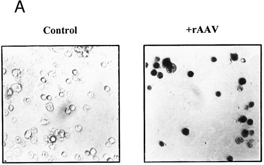 Fig. 3. Expression of LacZ transgene in developing T cells after rAAV-mediated gene transfer. CD34+CD2− cells were cultured on thymic stroma either with rAAV-LacZ at MOI of 10 or medium alone (control). CD2+ cells were FACS purified after 21 days and aliquotted for analysis of expression. (A) β-galactosidase activity: triplicate samples of 5 × 103 cells per well were incubated with X-gal at 150 μg/mL and enumerated by phase contrast microscopy with ×40 objective magnification. (B) Detection of LacZ mRNA in bulk or CD2+ T cells by RT-PCR. mRNA was prepared from equivalent numbers of cells and cDNA generated by RT with random hexamers. The products were amplified by PCR with primers specific for an internal region of LacZ or Gsα . Specificity of the PCR products was confirmed by Southern blot hybridization with a 32P-labeled probe specific for LacZ. A Hela cell line stably transfected with LTR-LacZ was used as a positive control, and analysis was repeated for three independent experiments.