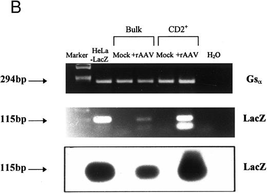 Fig. 3. Expression of LacZ transgene in developing T cells after rAAV-mediated gene transfer. CD34+CD2− cells were cultured on thymic stroma either with rAAV-LacZ at MOI of 10 or medium alone (control). CD2+ cells were FACS purified after 21 days and aliquotted for analysis of expression. (A) β-galactosidase activity: triplicate samples of 5 × 103 cells per well were incubated with X-gal at 150 μg/mL and enumerated by phase contrast microscopy with ×40 objective magnification. (B) Detection of LacZ mRNA in bulk or CD2+ T cells by RT-PCR. mRNA was prepared from equivalent numbers of cells and cDNA generated by RT with random hexamers. The products were amplified by PCR with primers specific for an internal region of LacZ or Gsα . Specificity of the PCR products was confirmed by Southern blot hybridization with a 32P-labeled probe specific for LacZ. A Hela cell line stably transfected with LTR-LacZ was used as a positive control, and analysis was repeated for three independent experiments.