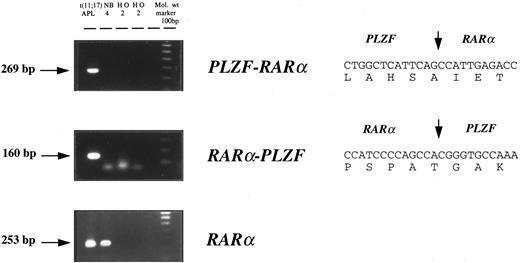 Fig. 1. Detection of PLZF-RARα and RARα-PLZF transcripts by nested RT-PCR in t(11; 17)(q23; q12-21)-associated APL. PLZF-RARα and RARα-PLZF cDNA sequences are shown on the right; the positions of RARα and PLZF fusion junctions are delineated by vertical arrows.