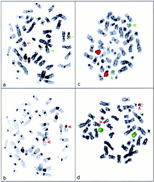Fig. 2. Cryptic PML-RARα fusion resulting from interstitial insertion of RARα into PML on 15q (case no. 2; Table 1). (a) FISH analysis using ICRF PML 15.5 (green) and RARα 121 (red) cosmid probes. The RARα probe hybridized to two chromosome 17s of normal appearance, whereas 1 normal PML locus was observed on chromosome 15. The PML-RARα fusion was detected on 15q (yellow arrow). Localization of the fusion gene was confirmed by subsequent hybridization with a chromosome 15 centromere probe, shown in red in (b). (c) Chromosome 15 paint (red); chromosome 17 centromere probe (green). (d) Chromosome 17 paint (green); chromosome 15 centromere probe (red)