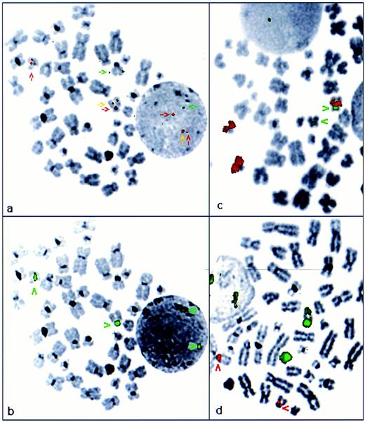 Fig. 3. PML-RARα fusion resulting from interstitial insertion of PML with associated chromosome 15-derived material into RARα on 17q (case no. 4; Table 1). (a) FISH analysis using ICRF PML (green) and RARα (red) cosmid probes. PML-RARα fusion gene was detected on 17q (yellow arrow), adjacent to RARα hybridization signal (red arrow). Splitting of the RARα- derived signal on der(17q) was indicative of insertion of PML and adjacent sequence into the genomic region covered by RARα cosmid 121. Localization of the PML-RARα fusion gene was confirmed by subsequent hybridization with a chromosome 17 centromere probe shown in green in (b). (c) Chromosome 15 paint (red) and chromosome 17 centromere probe (green), confirming insertion of chromosome 15-derived material into 17q. (d) Chromosome 17 paint (green), chromosome 15 centromere probe (red). Chromosome 17 paint remained localized to 17; der(17q) showed a region of absent signal corresponding to the inserted region of 15q shown in (c).
