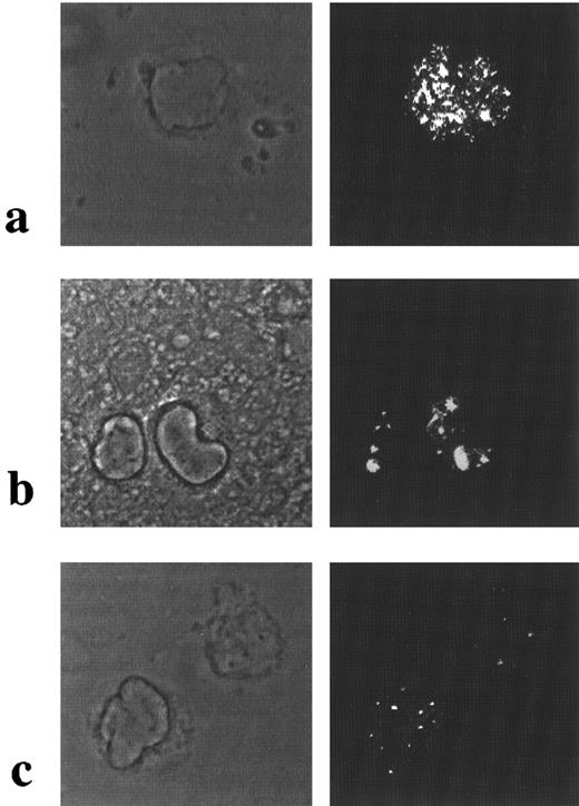 Fig. 4. PML immunofluorescence in AML using polyclonal antisera. Phase contrast is shown in left-hand panels and corresponding PML immunofluorescence on the right. In APL cases with cryptic PML-RARα rearrangements, a microparticulate pattern of PML nuclear staining was observed as shown in (a). In non-APL cases, a wild-type pattern of PML nuclear staining was detected, as shown in AML M2 blasts in (b); similar nuclear staining was observed in t(11; 17)-associated APL (case no. 7; Table 1), shown in (c).