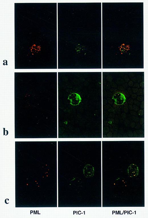 Fig. 5. PML and PIC 1 localization in AML. Dual immunofluorescence using PML monoclonal (left-hand panel) and PIC 1 polyclonal (center panel) antibodies. Images are fused in the right-hand panel; yellow signal denotes regions of PML/PIC 1 colocalization. (a) In APL cases associated with cryptic PML-RARα rearrangements, a microparticulate pattern of PML nuclear staining was associated with partial colocalization with PIC 1. In non-APL cases, eg, AML M4, shown in (b) and in t(11; 17)-associated APL (case no. 7; Table 1), shown in (c), PIC 1 was localized to the nuclear membrane and colocalized with PML within discrete nuclear bodies.