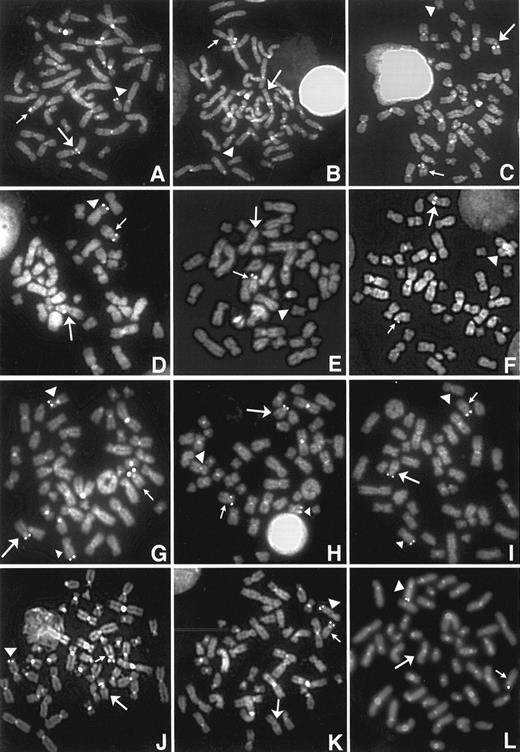 Fig. 1. Representative photograph of FISH signals for four patients (patients no. 3, 8, 10, and 13) in whom the FISH signals of the YAC 964c10 were observed to be split between the der(12) and the partner derivative chromosome. The left column (A, D, G, and J) shows the FISH signals of the YAC964c10, the middle column (B, E, H, and K) shows the signals of TEL exon 3 probe, and the right column (C, F, I, and L) shows the signals of P1 TEL probe in each patient. The small arrow indicates the normal chromosome 12, the large arrow indicates the derivative chromosome 12, and the arrowhead identifies the partner derivative chromosome. (A) FISH signals of the YAC964c10 were observed on the der(12), the der(8), and normal chromosome 12 in patient no. 3. (B and C) Signals of the TEL exon 3 and P1 TEL probes were observed only on the der(12) and normal chromosome 12. In patient no. 8, (D) FISH signals of the YAC964c10 were observed on the der(12), the der(6), and normal chromosome 12. (E) The TEL exon 3 probe was deleted from the der(12) and der(6). (F ) The signal of the P1 TEL was observed on the der(12) and normal chromosome 12. In patient no. 10, (G) FISH signals of the YAC964c10 were observed on the der(12), the der(9) (large arrowhead), mar1 (small arrowhead), and normal chromosome 12. (H and I) The signals of the TEL exon 3 and P1 TEL probes were observed only on the der(12), the mar1, and normal chromosome 12. In patient no. 13, (J) FISH signals of the YAC964c10 were observed on the der(12), the der(5), and normal chromosome 12. (K and L) Signals of the TEL exon 3 and P1 TEL probes were observed only on the der(5) and normal chromosome 12.