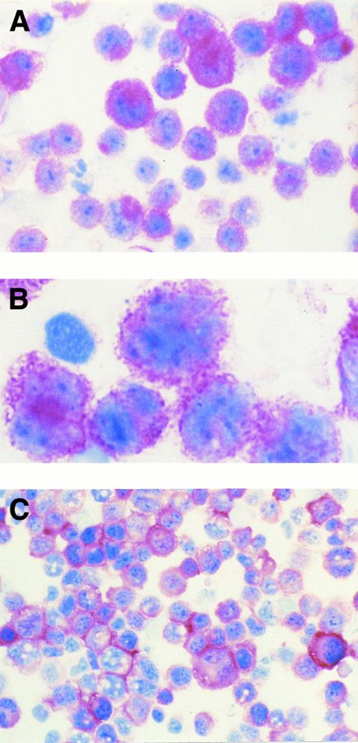 Fig. 1. (A) AIDS-related KSHV+ PEL (patient no. 5). The majority of tumor cells show strong cytoplasmic and membrane staining for B-B4 antibody that recognizes the plasma cell-specific CD138/syndecan-1 antigen. Cytospin preparation, APAAP immunostaining, hematoxylin counterstain. (Original magnification × 400.) (B) AIDS-related KSHV+ PEL (patient no. 5). High power photograph showing pleomorphic tumor cells with intense membrane staining for B-B4 antibody. Cytospin preparation, APAAP immunostaining, hematoxylin counterstain. (Original magnification × 1,000 oil immersion.) (C) AIDS-related KSHV+ PEL-derived cell line (HBL-6). Cultured cells show a dominant membrane staining for B-B4 antibody. Cytospin preparation, APAAP immunostaining, hematoxylin counterstain. (Original magnification × 320.)