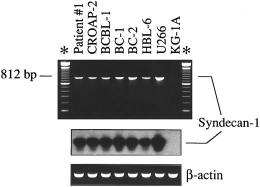Fig. 2. Expression of mRNA encoding for CD138/syndecan-1 in primary tumor cells from a patient with PEL (patient no. 1), human PEL-derived cell lines (CROAP-2, BCBL-1, BC-1, BC-2, and HBL-6), the human myeloma cell line U266, and myeloid leukemia cells KG-1A, as detected by RT-PCR analysis. cDNA bulks were prepared and amplified with specific primers for human syndecan-1 (upper panel) and β-actin (lower panel). Ten microliters of amplified cDNAs was also run on 1.5% agarose gels, blotted onto nylon membranes, and hybridized with a syndecan-1–specific cDNA probe (center panel).