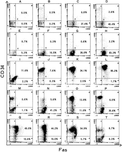 Fig. 4. Normal BM MNC (A-D) and representative data of 16 AML cells (E-T) of two-color flow cytometric analysis of Fas expression and CD34 expression. (A) Two isotypic control antibodies, (B) FITC control antibody and PE-conjugated anti-CD34 MoAb, (C) FITC-conjugated anti-Fas MoAb and PE control antibody, (D-T) FITC-conjugated anti-Fas MoAb and PE-conjugated anti-CD34 MoAb. In contrast to normal BM MNC (D) whose CD34+ cells are Fas−, some CD34+ cell in AML express Fas. Various patterns of distribution are shown; the single population group (SP, E-L), the two-population group (TP, M-N), and the wide distributed group (WD, Q-T).