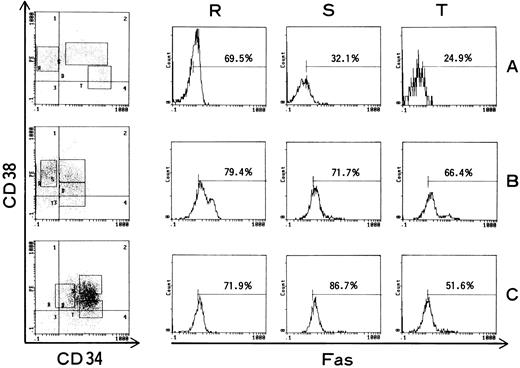 Fig. 5. Representative data of three-color analysis of three AML cells. Cells were stained with anti-Fas–FITC, anti-CD38–PE, and anti-CD34–PE-Cy5. The left side shows a two-dimensional picture of CD34 and CD38. Electric gates were set to contain CD34− (R), CD34+/CD38+ (S) and CD34+/CD38± (T) cells. On the right, the histograms showing Fas expression on the three gated populations are presented.