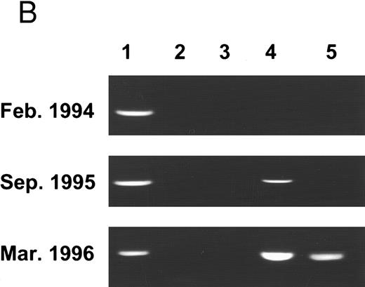 Fig. 1. (A) Pa methylation analysis in different phases of CML: 201 samples of 99 CML patients and 12 samples of non-CML patients underwent molecular analysis. The bars represent the ratio of samples characterized by patterns A, B, or C in each phase of the disease. The numbers (N) above the bars indicate the number of samples of a given pattern. (B) PCR analysis of Pa methylation of an individual patient in different phases of the disease: genomic DNA was cut with BamHI (1), Msp I (2), Bgl II (3), Sac II (4), and Hpa II (5). After digestion, samples were amplified by PCR and analyzed on ethidium-bromide agarose gel. On diagnosis, the patient displayed pattern A. Nineteen months later, the patient was still in the chronic phase, but the Sac II site was already methylated (pattern B). After an additional 5 months, the patient was in blastic crisis with evidence of methylation at both the Sac II and the Hpa II sites (pattern C).