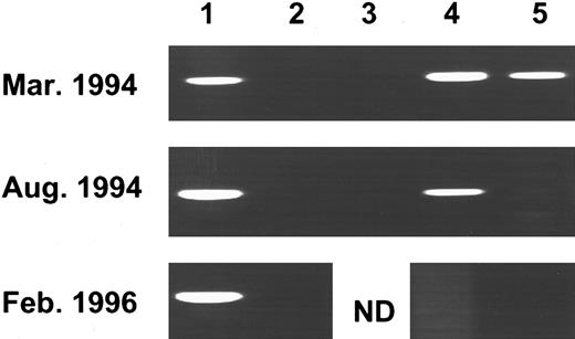 Fig. 3. PCR analysis of Pa methylation of an individual patient before and during IFNα treatment. Genomic DNA was cut with BamHI (1), Msp I (2), Bgl II (3), Sac II (4), and Hpa II (5) and processed for the Pa methylation assay (see Fig 1B). The patient diagnosed in the accelerated phase was classified as pattern C. Six months later, under IFNα therapy, pattern B was evident, and 23 months after diagnosis, the methylation pattern was A.