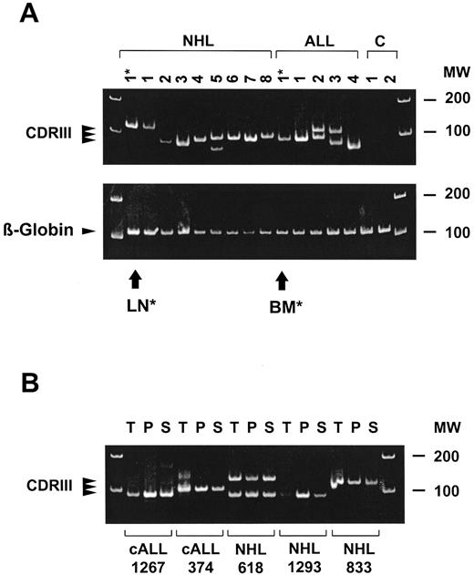 Fig. 1. Detection of CDRIII DNA in the plasma of patients with B-cell malignancies. (A) CDRIII DNA amplified from the plasma of eight representative patients with NHL, four patients with B-precursor ALL at diagnosis, and two healthy control subjects. PCR-products derived from diagnostic tumor material of one NHL patient (lymph node: LN*, lane 1) and one ALL patient (bone marrow: BM*, lane 10) are included for comparison. Positive β-globin bands show the presence of DNA in all samples. (B) Comparison of CDRIII DNA amplification products in tumor cell samples (T), plasma (P), and serum (S) from five representative patients (two ALL and three NHL). PCR products were cloned and DNA sequences were found to be identical in each patient (summarized in Table 1). Ethidium bromide stained polyacrylamide gels; MW indicates molecular weight markers.