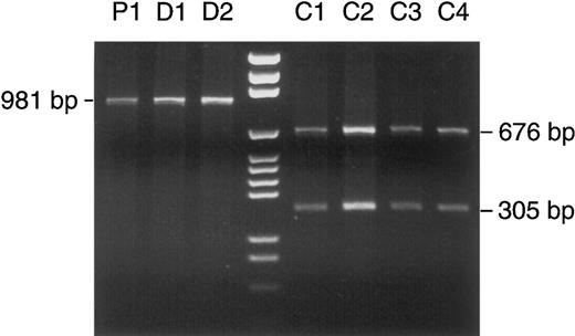 Fig. 6. Detection of a homoplasmic polymorphism in patient no. 1 and her two daughters. PCR-amplified mtDNA segment no. 9 (nt 8282-9262) was treated with Taq I. According to the Cambridge sequence, Taq I has a restriction site at nt 8957, which divides the segment of 981 bp into two fragments of 676 and 305 bp. In patient no. 1 (lane P1) and her two daughters (D1 and D2), complete (homoplasmic) loss of the restriction site left the PCR product intact after Taq I digestion, whereas the expected cleavage occurred in four other patients (C1 through 4). Lane 4, DNA size marker (pGEM).