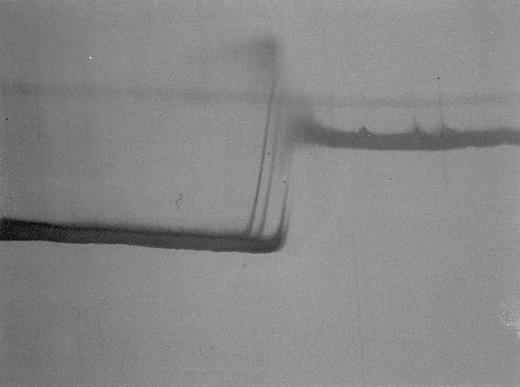 Fig. 7. Perpendicular TGGE in patient no. 2. MtDNA fragment, nt 6504-6923. 5% polyacrylamide gel, silver staining. The typical heteroduplex pattern (two clearly separated heteroduplex bands on the left, two homoduplex bands not clearly separated on the right) indicates the presence of two homologous mtDNA species (wild-type and mutated), which after a cycle of denaturation and renaturation produce hybrids differing in their melting behavior.