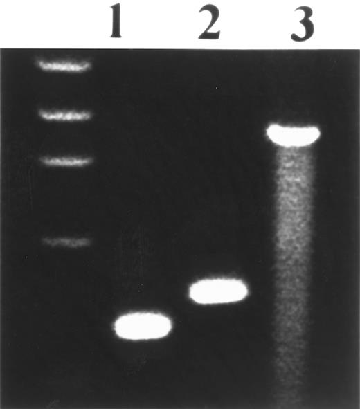 Fig. 1. Agarose gel electrophoresis of RT-PCR–amplified BCR/ABL chimeric transcripts. Lane 3 corresponds to the reported patient; lanes 1 and 2 correspond to two control patients with CML bearing b2a2 and b3a2 junction, respectively. The patient's band, resulting from the fusion of BCR exon 19 and ABL exon 2, is 540 bases longer than that of the b3a2 junction.