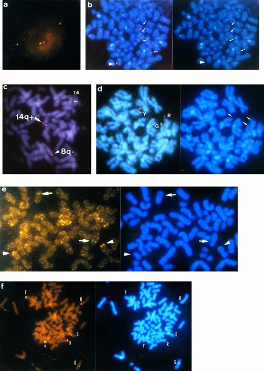 Fig. 1. Interphase and metaphase FISH using VH and Cγ gene. DAPI banding pictures are shown on the right side of the corresponding FISH metaphases except for (c). (a) Split pattern of VH (TRITC, red) and Cγ (FITC, green) gene signals in interphase nuclei of patient no. 45 with MGUS. (b) Metaphase FISH on patient no. 41 with t(11; 14). Signals of VH (red) and Cγ (green) genes are observed on 11q− and 14q+, respectively (arrows). An arrowhead indicates normal chromosome 14. (c) Metaphase FISH on patient no. 1 with t(8; 14). Through tripple-band-pass filter, signals of split VH (arrowhead, pink) and Cγ-split VH (double arrowhead, whitish pink) genes are observed on 8q− and 14q+, respectively. Normal chromosome 14 was labeled with whitish pink signal of the IgH gene (arrow). In this patient, the breakpoint of the IgH gene is possibly within the variable region. (d) Metaphase FISH on patient no. 20 with t(14; 18). Cγ (G, green) and VH (R, red) signals are observed on 14q+ and 18q−, respectively. Y (yellow) denotes a normal allele of the IgH gene. (e) Metaphase FISH on patient no. 11 with t(7; 14). Signals of VH (arrowheads) and Cγ (arrows) genes are observed on 7q− and 14q+, respectively. (f ) Metaphase FISH on patient no. 2 with complex 14q32.33 translocation involving 3q and 16q24. Signals of VH (R) and Cγ (G) genes are observed on 3q− and 16q, respectively. Y indicates normal chromosome 14.