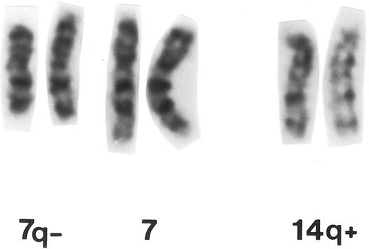Fig. 2. Partial G-banded karyotype of patient no. 11 with MM carrying t(7; 14)(q32.1; q32.33).