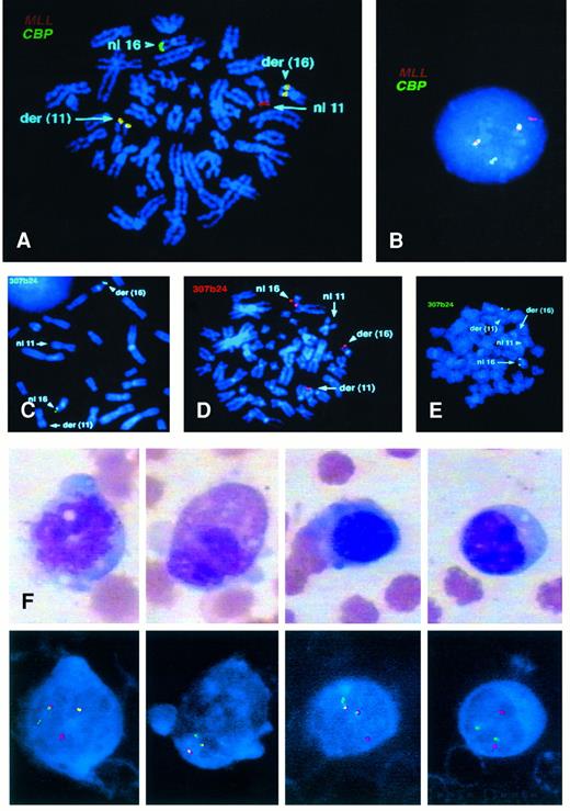 Fig. 2. (A) Upper Left. Metaphase cell from patient no. 8 labeled with MLL (chromosome 11 in red) and CBP (chromosome 16 in green). The two derivative chromosomes show a fusion signal. (B) an interphase cell from patient no. 6 labeled as in (A). (C) Middle left. Metaphase cell from patient no. 2 showing the PAC probe (307624) labeling the normal 16 and the der(16). (D) Center. Metaphase cell from patient no. 8 showing the PAC probe splitting and labeling both the der(11) and der(16) as well as the normal 16. (E) Right. Metaphase cell from patient no. 1 showing the PAC on the normal 16 and on the der(11). Lineage analysis in patient no. 6. Lower panel. Monocyte, granulocyte, erythroid precursor, and mature lymphocyte (F, G, H, and I, respectively) and the corresponding FISH results below from patient no. 6 with CMMoL-like tMDS. The monocyte, granulocyte, and erythroid precursor show the pattern of one red, one green, and two fusion signals, indicating the presence of MLL/CBP translocation on the der(11) and der(16) chromosomes, whereas the lymphocyte shows the pattern of a normal (nonclonal) cell with two red and two green signals.