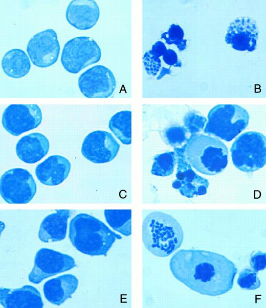 Fig. 3. Morphologic changes showing features of apoptosis in B-CLL cell lines after treatment with melarsoprol for 24 hours (original magnification × 600). (A) Untreated WSU-CLL cells; (B) 10−8 mol/L melarsoprol-treated WSU-CLL cells; (C) untreated I83CLL cells; (D) 10−8 mol/L melarsoprol-treated I83CLL cells; (E) untreated JVM-2 cells; (F ) 10−8 mol/L melarsoprol-treated JVM-2 cells. The cells were stained using Giemsa-Wright stain.
