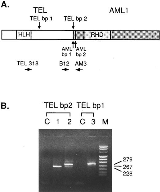 Fig. 1. Representative analysis of RT-PCR amplification of the TEL/AML1 chimeric transcripts in t(12; 21) ALL samples. (A) The relative position of the primers used to amplify the TEL/AML1 fusion cDNAs resulting from the most common breakpoint within the TEL gene (TEL bp-2) and the one occuring at a more 5′ site (TEL bp-1) is shown. The amplified fragment in the lane corresponding to patient n.1 is slighty shorter than usual (as in case n.2), lacking the 39 bp-AML1 exon 2. The sequence analysis of the cDNA product obtained from patient n.3, showed the junction of the exon 4 of the TEL gene to exon 2 of the AML1 gene.