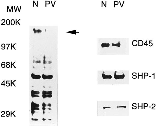 Fig. 1. Tyrosine phosphorylation of cellular proteins and expression of SHP-1, SHP-2, and CD45 in normal (N) and PV ECFC. Day-6 ECFC were collected from suspension cultures, washed with phosphate-buffered saline, and lysed in buffer A with 1% Triton X-100. Equal amounts of extracts (25 μg) were subjected to SDS-PAGE and analyzed with antiphosphotyrosine (left panel) or the indicated anti-PTP antibodies (right panel). Purities of the ECFC were 75% and 70% for normal and PV samples, respectively. A representative figure from three experiments with similar results is shown. Each experiment was performed with blood samples from different normal volunteers and PV patients.