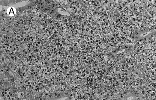 Fig. 1. NHL associated with SS (hematoxylin-eosin stains). (A) Case no. 13. Low-grade B-cell lymphoma of MALT type in the stomach, composed mainly of centrocyte-like cells with a few small lymphocytes and plasma cells. (B) Case no. 15. Low-grade B-cell lymphoma of MALT type in the parotid. Lymphoepithelial lesions are numerous, surrounded by centrocyte-like cells. (C) Case no. 6. Remnants of a germinal center in a low-grade B-cell lymphoma of MALT type in the parotid. / (D) Case no. 10. Immunocytoma in lymph node. The infiltrate is composed of small lymphocytes, plasma cells and blasts. (E) Case no. 14. Monocytoid B-cell lymphoma in a cervical lymph node with a monocytoid component located in dilated sinuses. / (F ) Case no. 2. High-grade B-cell lymphoma in the stomach (centroblastic lymphoma; upper), with remnants of low-grade lymphoma of MALT type (lower).