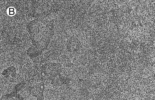 Fig. 1. NHL associated with SS (hematoxylin-eosin stains). (A) Case no. 13. Low-grade B-cell lymphoma of MALT type in the stomach, composed mainly of centrocyte-like cells with a few small lymphocytes and plasma cells. (B) Case no. 15. Low-grade B-cell lymphoma of MALT type in the parotid. Lymphoepithelial lesions are numerous, surrounded by centrocyte-like cells. (C) Case no. 6. Remnants of a germinal center in a low-grade B-cell lymphoma of MALT type in the parotid. / (D) Case no. 10. Immunocytoma in lymph node. The infiltrate is composed of small lymphocytes, plasma cells and blasts. (E) Case no. 14. Monocytoid B-cell lymphoma in a cervical lymph node with a monocytoid component located in dilated sinuses. / (F ) Case no. 2. High-grade B-cell lymphoma in the stomach (centroblastic lymphoma; upper), with remnants of low-grade lymphoma of MALT type (lower).
