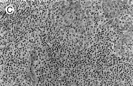 Fig. 1. NHL associated with SS (hematoxylin-eosin stains). (A) Case no. 13. Low-grade B-cell lymphoma of MALT type in the stomach, composed mainly of centrocyte-like cells with a few small lymphocytes and plasma cells. (B) Case no. 15. Low-grade B-cell lymphoma of MALT type in the parotid. Lymphoepithelial lesions are numerous, surrounded by centrocyte-like cells. (C) Case no. 6. Remnants of a germinal center in a low-grade B-cell lymphoma of MALT type in the parotid. / (D) Case no. 10. Immunocytoma in lymph node. The infiltrate is composed of small lymphocytes, plasma cells and blasts. (E) Case no. 14. Monocytoid B-cell lymphoma in a cervical lymph node with a monocytoid component located in dilated sinuses. / (F ) Case no. 2. High-grade B-cell lymphoma in the stomach (centroblastic lymphoma; upper), with remnants of low-grade lymphoma of MALT type (lower).