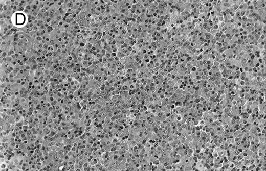 Fig. 1. NHL associated with SS (hematoxylin-eosin stains). (A) Case no. 13. Low-grade B-cell lymphoma of MALT type in the stomach, composed mainly of centrocyte-like cells with a few small lymphocytes and plasma cells. (B) Case no. 15. Low-grade B-cell lymphoma of MALT type in the parotid. Lymphoepithelial lesions are numerous, surrounded by centrocyte-like cells. (C) Case no. 6. Remnants of a germinal center in a low-grade B-cell lymphoma of MALT type in the parotid. / (D) Case no. 10. Immunocytoma in lymph node. The infiltrate is composed of small lymphocytes, plasma cells and blasts. (E) Case no. 14. Monocytoid B-cell lymphoma in a cervical lymph node with a monocytoid component located in dilated sinuses. / (F ) Case no. 2. High-grade B-cell lymphoma in the stomach (centroblastic lymphoma; upper), with remnants of low-grade lymphoma of MALT type (lower).